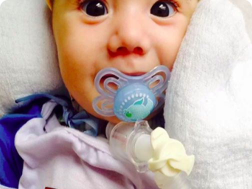 Bebê com olhos expressivos usando chupeta e tubo de traqueostomia, deitado sobre uma toalha branca