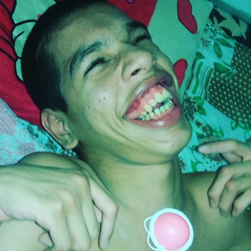 Junte-se a nós nesta corrente do bem ,preciso muito da sua solidariedade para ajudar meu filho com uma melhor qualidade de vida, tudo para ele é de uso contínuo, tudo precisa de sedação, tudo particular, e como eu não posso trabalhar para ajudar ele,fica muito difícil manter uma imensa despesa com o salário que ele recebe, ele usa 1 pacote de fralda por dia e todas as vezes que a fralda é trocada faço uso de higiene pessoal nele,criei um perfil no Instagram para que a nossa história tenha repercussão e vá para um programa de TV para conseguir um veículo para condução dele para hospital ,ele precisa de um bom plano de saúde que atenda pac-espec pois precisa fazer tratamento dos dentes, já não estou conseguindo mais cuidar dos dentes dele, acompanhe a nossa história de vida através do Instagram @ajudeojoaovitor 