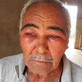 Benício diagnosticado com câncer de próstata de grau bem avançado , solteiro, não tem filhos, tem 76 anos mora só, vamos juntos nessa corrente do bem em prool de seu exames ,medicações ,cirurgia pra retarda o crescimento   