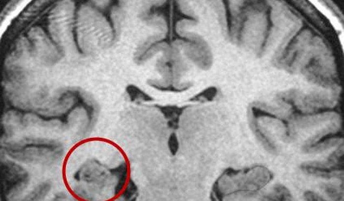 Epilepsia do lobo temporal mesial associada à esclerose