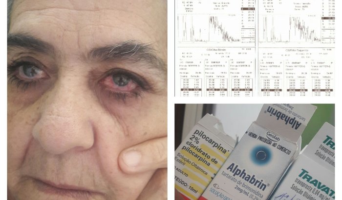 Cirurgia de Glaucoma