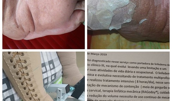Ajude-nos com o tratamento da Elefantiase 