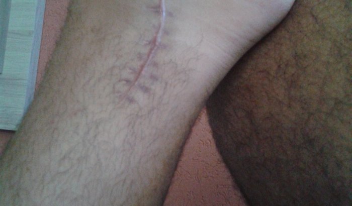 Pagar despesas após minha fratura
