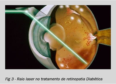 TRATAMENTO DA VISÃO DA MINHA MÃE 