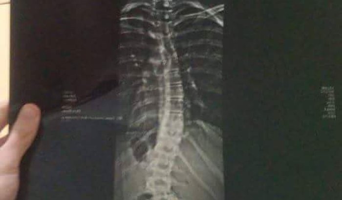  Ajude me a fazer a Cirurgia na coluna