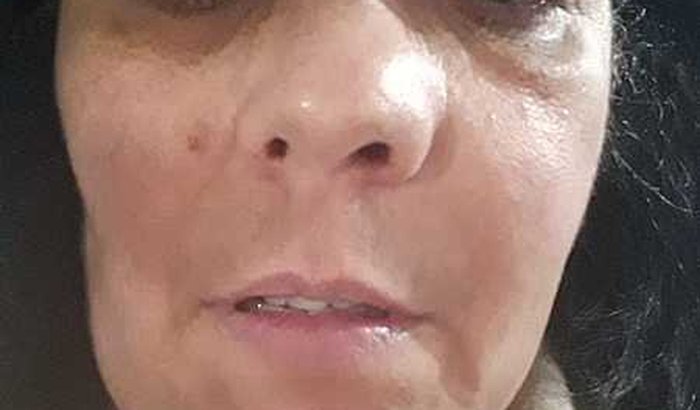 AJUDE JERUSA CAMPOS, Na retirada de um Câncer na face