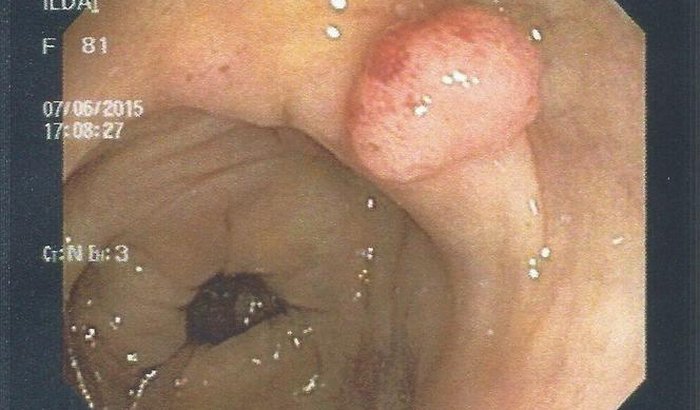 Cirurgia de CÓLON para a minha sogra URGENTE!