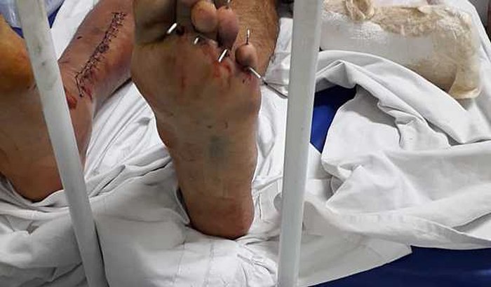 Ajudem meu irmão GERALDO , pernas com platina e pinos no pé