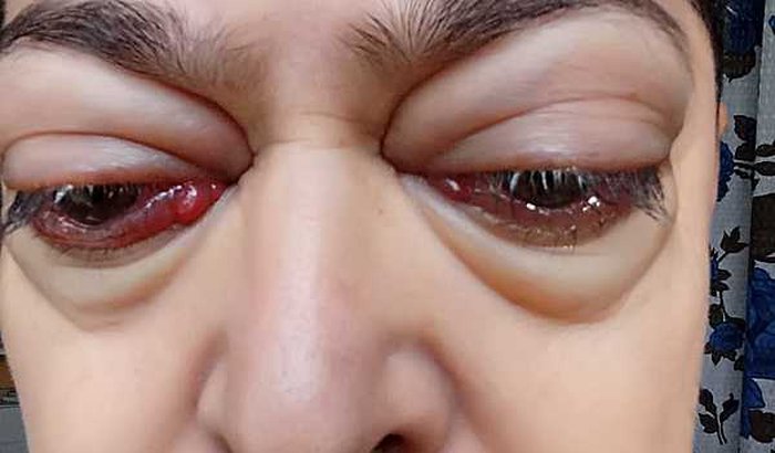 Cirurgia de Descompressão da órbita