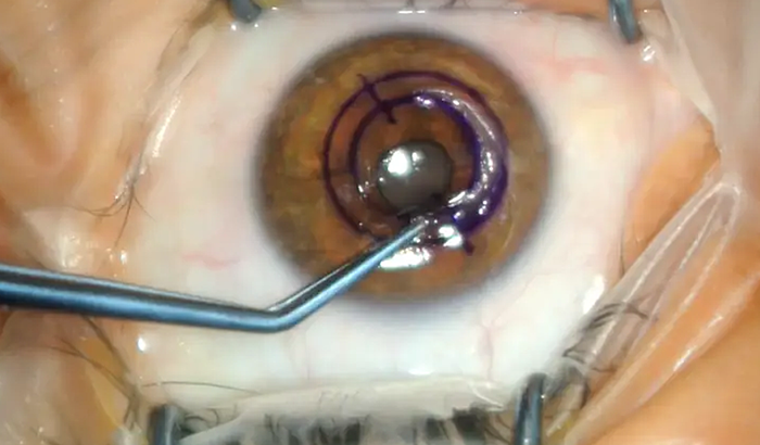 Cirurgia Ceratocone Gustavo