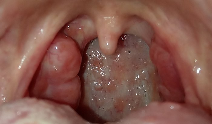 Cirurgia para retirada das amígdalas