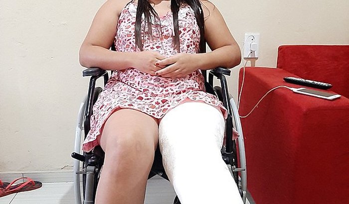 Cirurgia de Tíbia  (Osteossítese) + Placa bloqueada