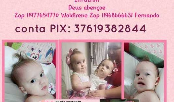 Ajuda para gêmeas siamesas Heloá e Valentina