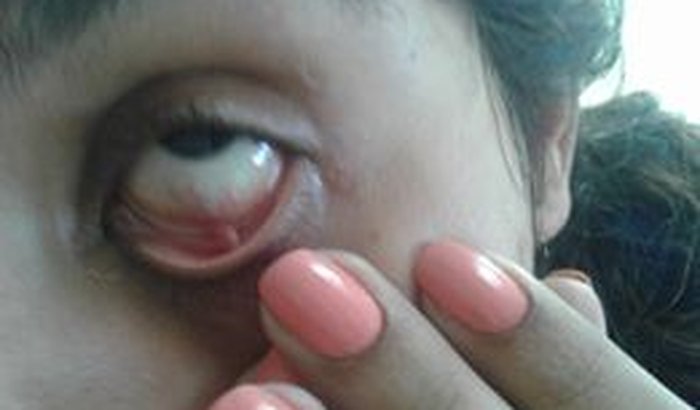 Cirurgia de retirada de tumor ocular