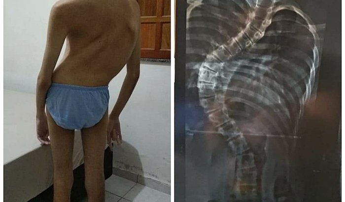 Cirurgia de Escoliose/Lordose