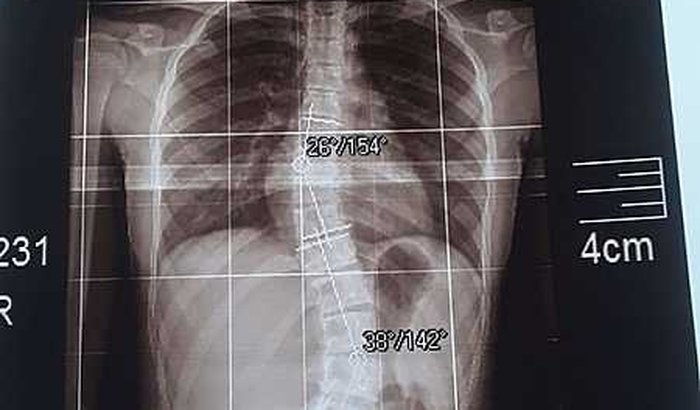 Cirurgia Escoliose / Para Anísia Santos