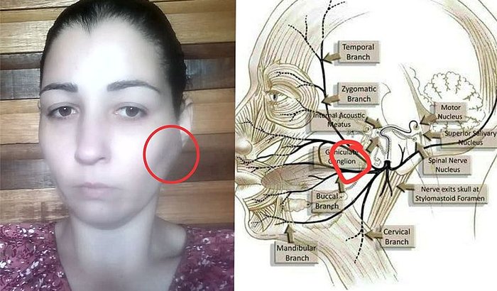 Cirurgia Delicada de Emergência Parotidectomia Parcial da Maiana