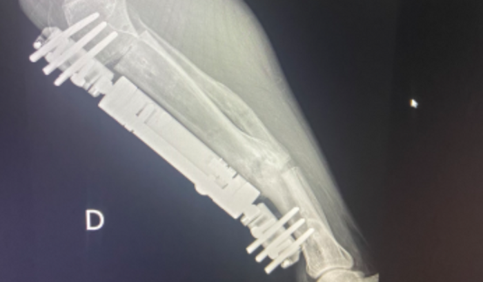 Ausência de Consolidação da Fratura ( Pseudo - Artose