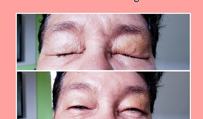 Ajuda para conseguir fazer cirurgia nos olhos