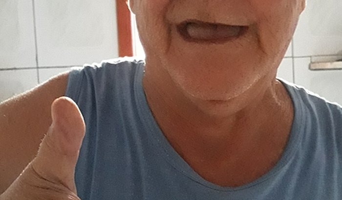 Prótese dentária para o Sarti Pai