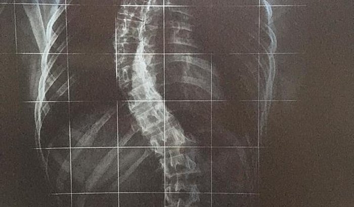 Cirurgia escoliose urgente!