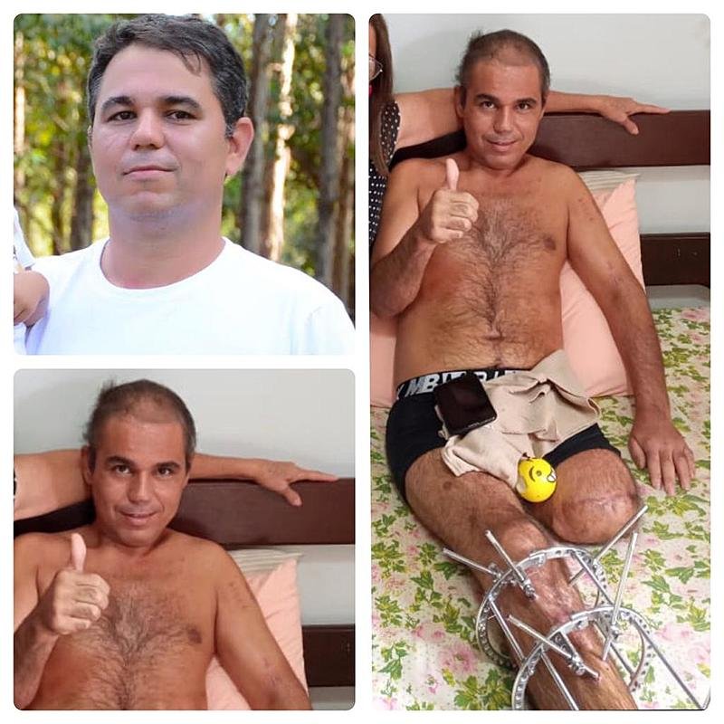 imagem da vaquinha Ajuda  Prótese Perna e Prótese Audição  Aneilton Batata