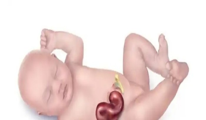 Cirugia de GASTROQUISE