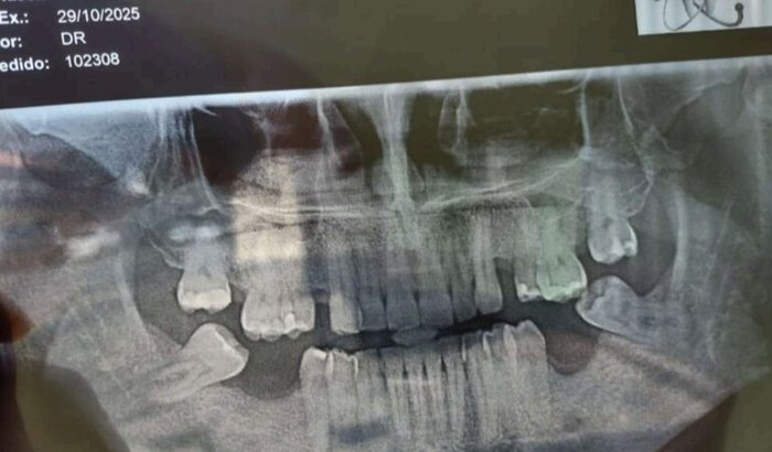 Implante dentário.