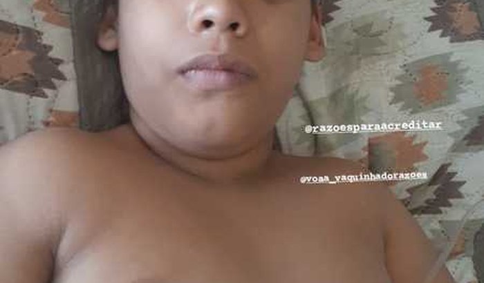 Cirurgia de crâniocinostose reconstrução craniana para carlinhos