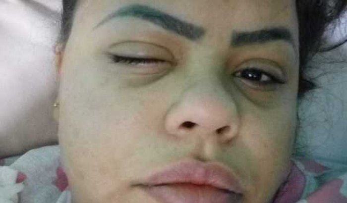 AJUDA PARA CIRURGIA DE CERATOCONE