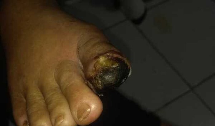 CIRURGIA DE UM DEDO NECROSADO DEVIDO A DIABETE DA MAE