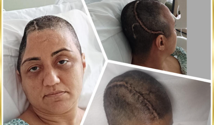 AJUDE ANDREZA A COLOCAR UMA PRÓTESE CRANIANA E SE RECUPERAR