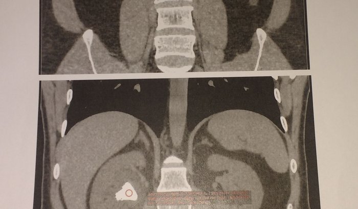 Cirurgia Litotripsia percutânea rim