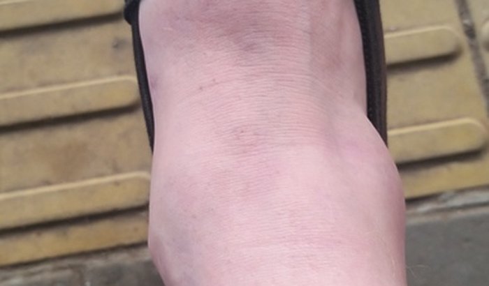 Ajuda para marcos fazer ressonância magnética com contraste.