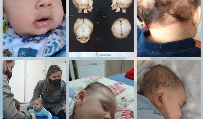 Ajuda pra comprar capacete para assimetria craniana