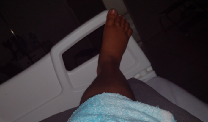 Tratamento d tranbose