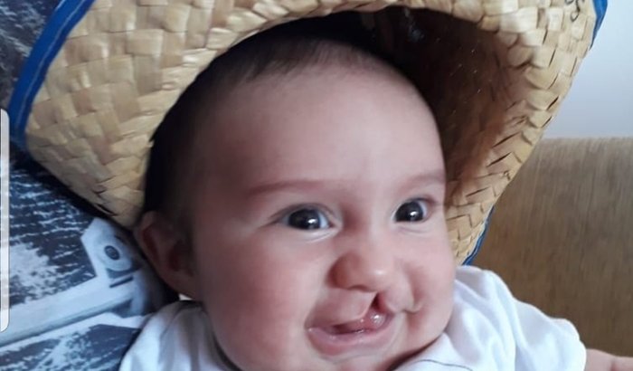 Cirurgia palatoplastia do JOAQUIM