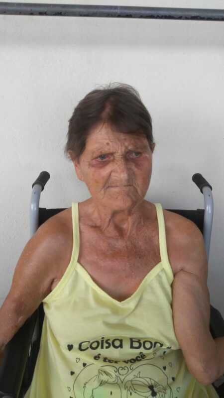 Tratamento saúde para idosa deficiente com múltiplas fraturas na perna