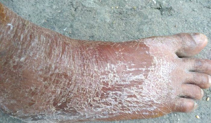 Germe no pé direito