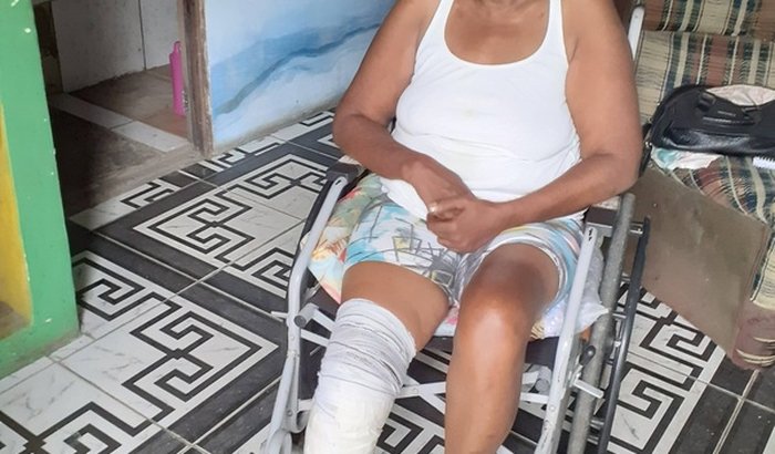 Protese Para Andressa (Cida)