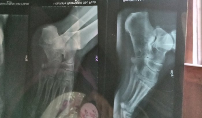 Artrodese intervascular