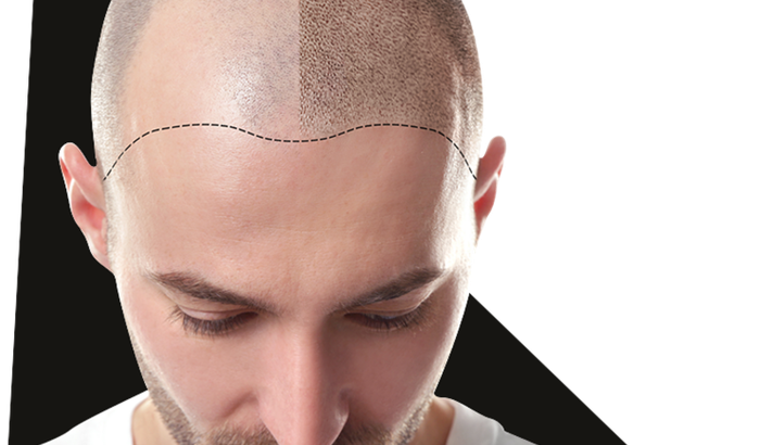 Ajuda para Implante Capilar