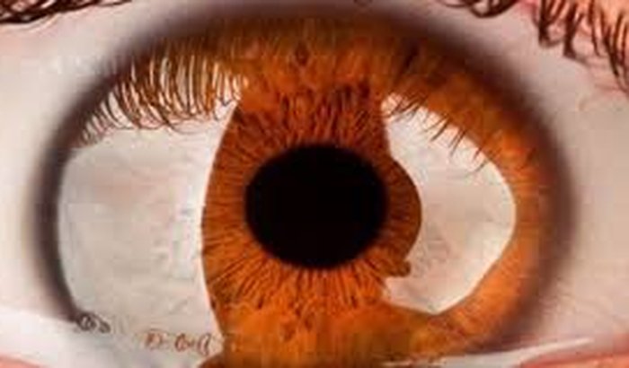 Cirurgia do Buraco Macular
