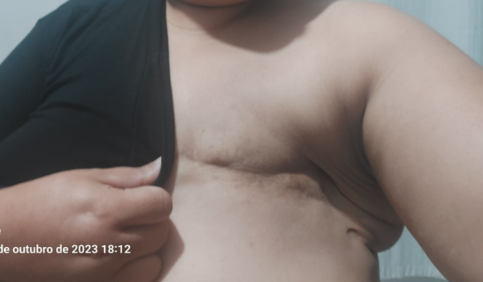 Campanha Bariatrica para reconstrução da mama. 