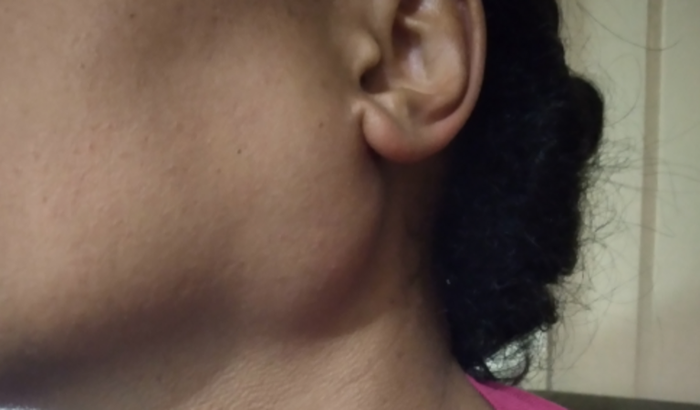 Cirurgia de nódulo de glândula de parotida