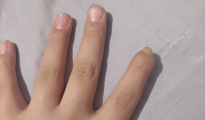 Prótese para dedo indicador