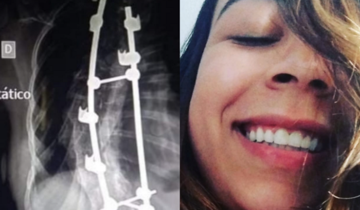 DESPESAS HOSPITALARES | Cirurgia de Escoliose