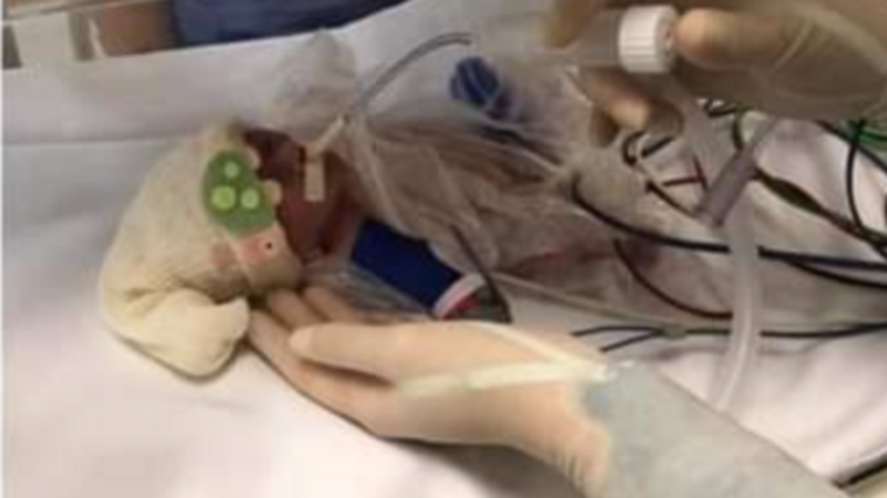 Ajuda a dois bebês gêmeos prematuros 