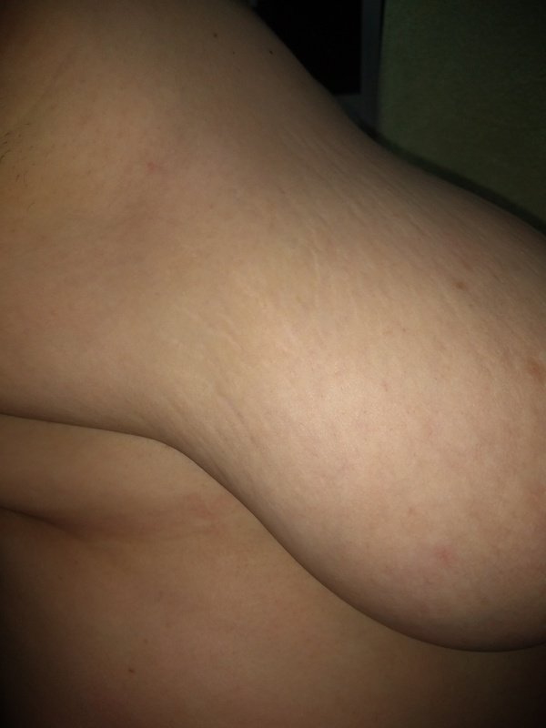 Ajuda pra redução do seios da minha esposa com depressão.