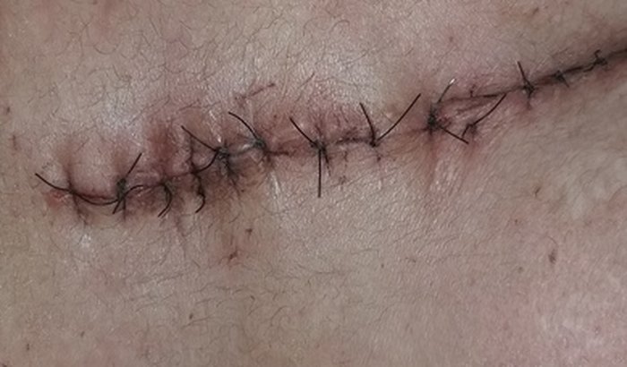 Ajuda para CIRURGIA IMPLANTE DE NEUROESTIMULADOR MEDULAR PARA TRATAMENTO DE DOR CRONICA  120.000.00